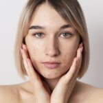 Лечение постакне